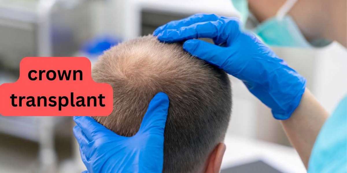 Crown Transplant: Restore Your Hairline Naturally