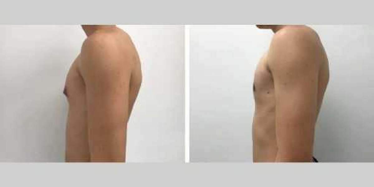 How the Best Gynecomastia Surgeons in Dubai Deliver Long-Term Results
