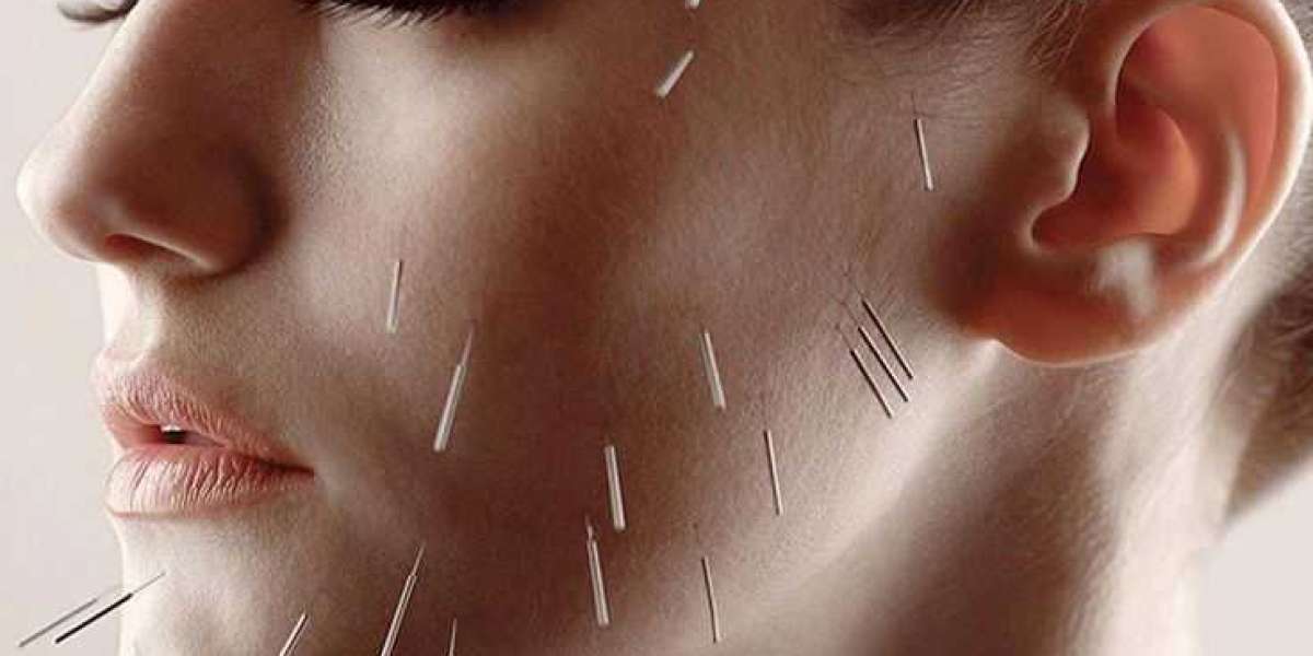 Top Micro Needling with Acupuncture Benefits for Skin and Wellness