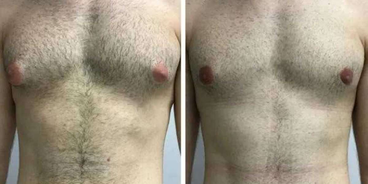 Patient Experiences: Living with Gynecomastia in Dubai