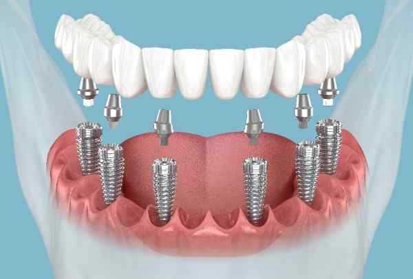 Dental implants Widnes