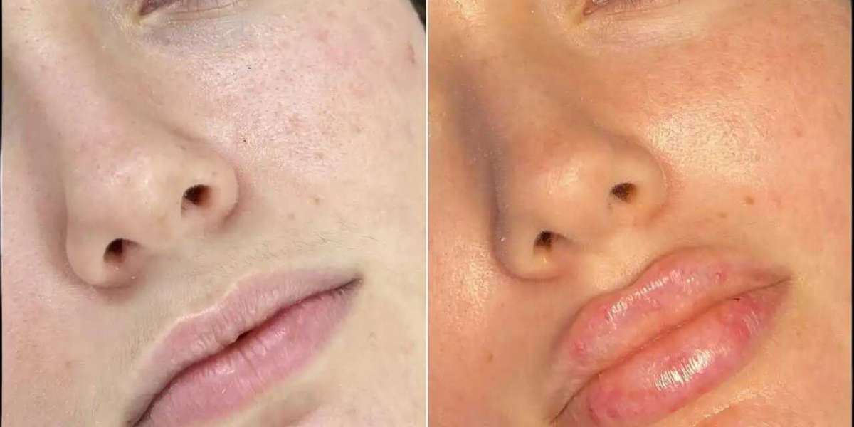 Best Doctors in dubai for Safe and FDA-Approved Fillers Treatments