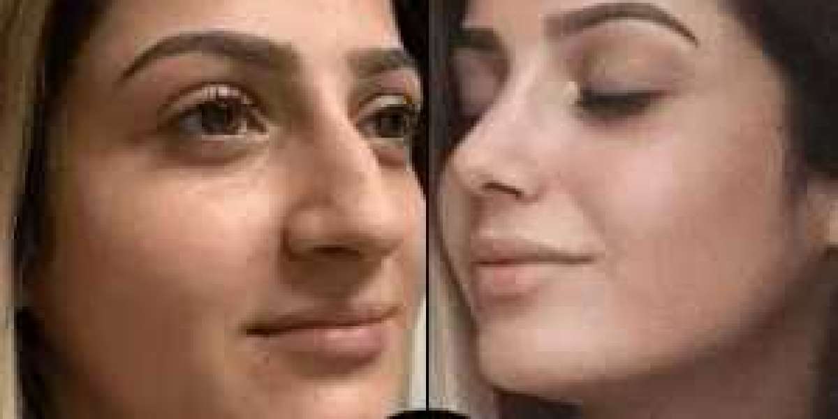 Long-Lasting Skin Glow with PRP Treatments in Dubai
