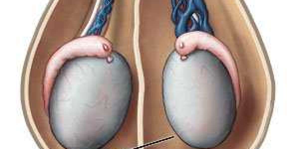 Best Varicocele Treatments for Pain Relief and Fertility Boost