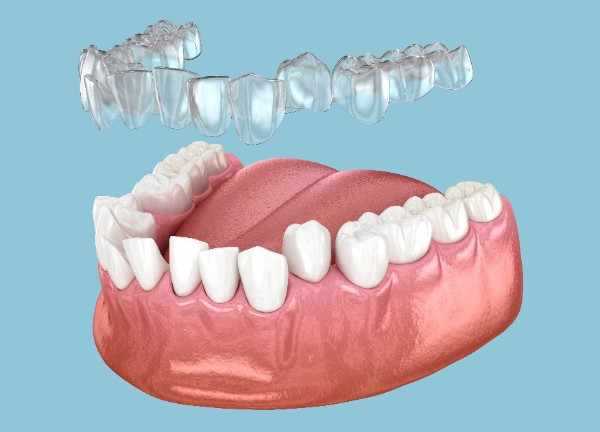 Invisalign Edinburgh