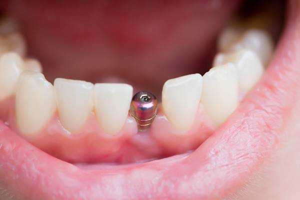 dental implants Edinburgh
