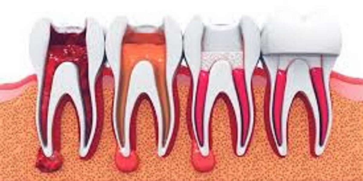 root canal treatment in Bahrain