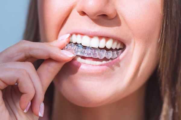  invisalign Widnes