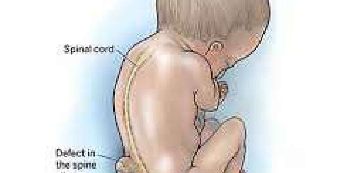 Spina Bifida in Ireland  Support, Care, and Progress