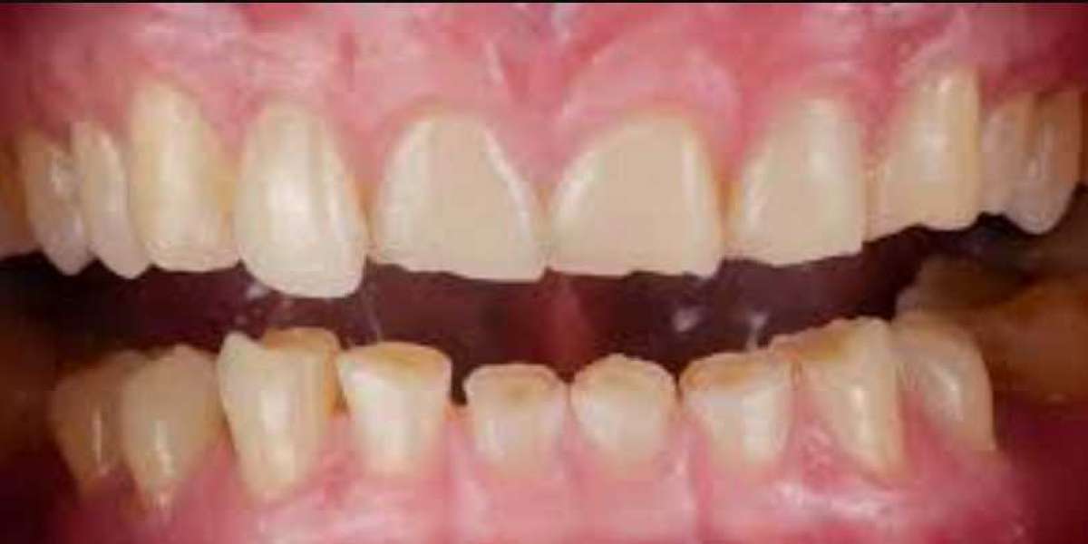 Advanced Orthodontics in Nagpur: Braces, Aligners, and Customized Smile Correction at Chandak Dental Clinic
