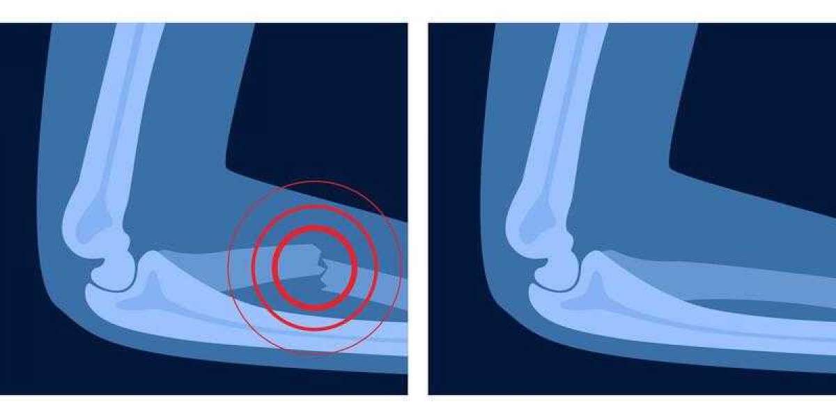 Managing Fracture Pain Effectively with Aspadol 100mg