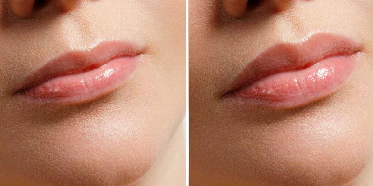 The Role of Lip Fillers in Anti-Ageing Treatments