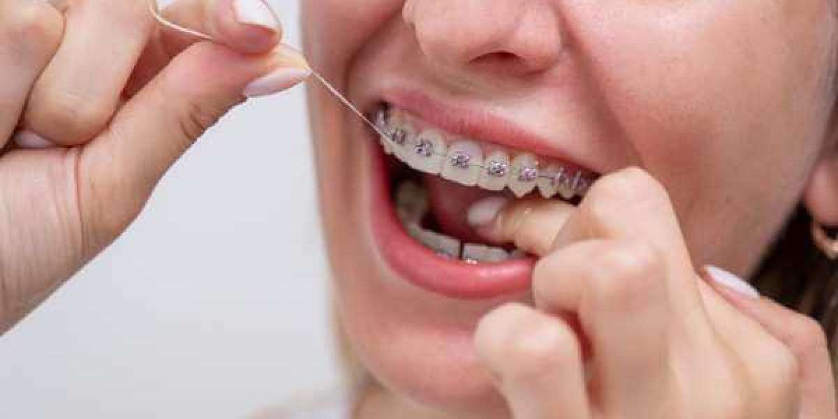 Straightening a Single Tooth with Braces or Aligners in Grimsby