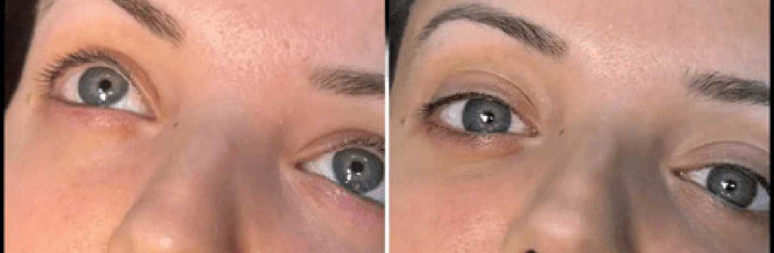 dermal fillers Cover Image