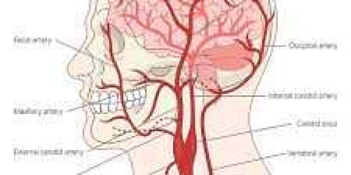 Carotid Artery Stenting in India: A Safe, Advanced & Life-Saving Stroke Prevention Solution at IRfacilities