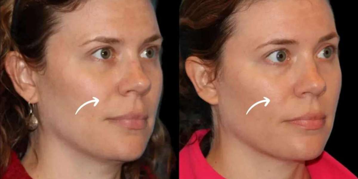 Best Aesthetic Clinics in Dubai for Sculptra Loose Skin