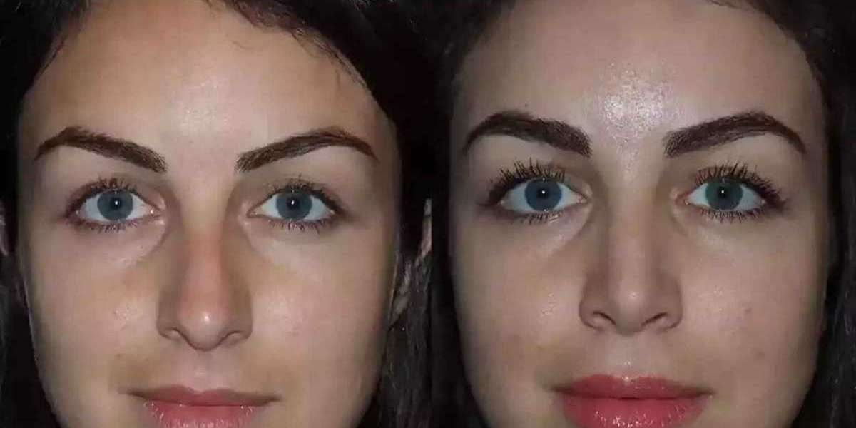 Best Doctors in Dubai Delivering Trusted Septoplasty Care