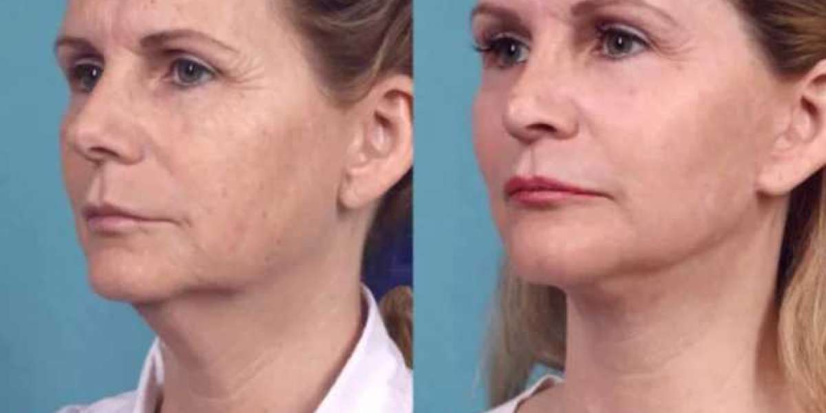 Best Plastic Surgeons in dubai Share Expert Tips on Chemical Peel Maintenance