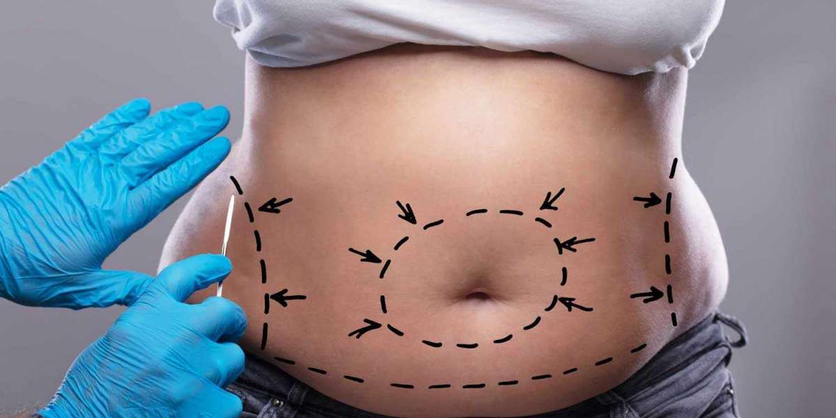 Tummy Tuck Dubai: What to Expect During Consultation