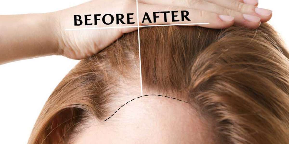 Transform Your Look Instantly with Advanced Hair Replacement