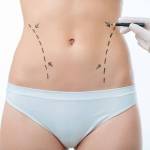 Liposuction in Riyadh Saudia Profile Picture
