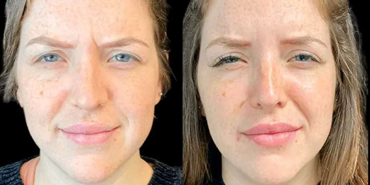 Botox Treatments in Dubai for Fine Lines and Facial Rejuvenation