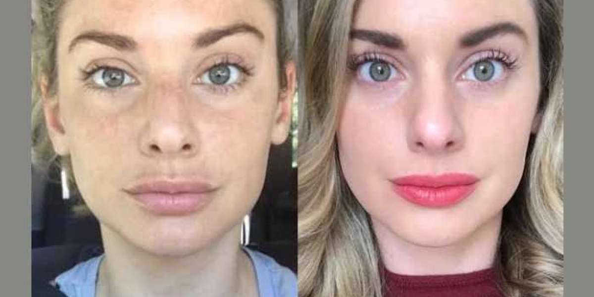 Radiofrequency (RF) Microneedling Treatment in Dubai for Smooth and Radiant Skin