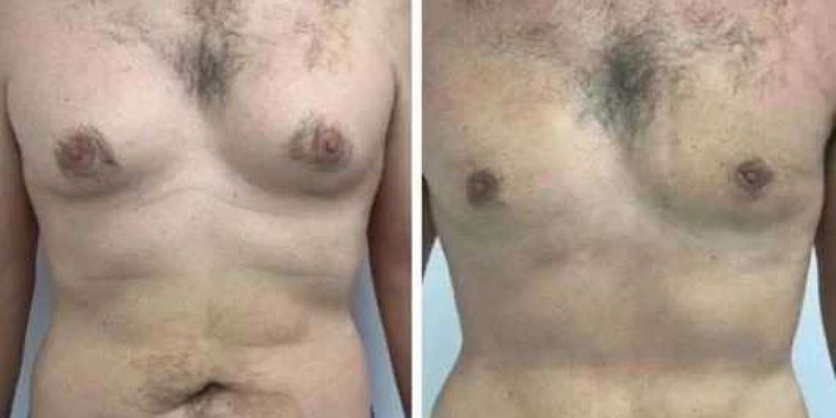 Gynecomastia Surgery in Dubai: Modern Solution for Persistent Male Chest Fullness