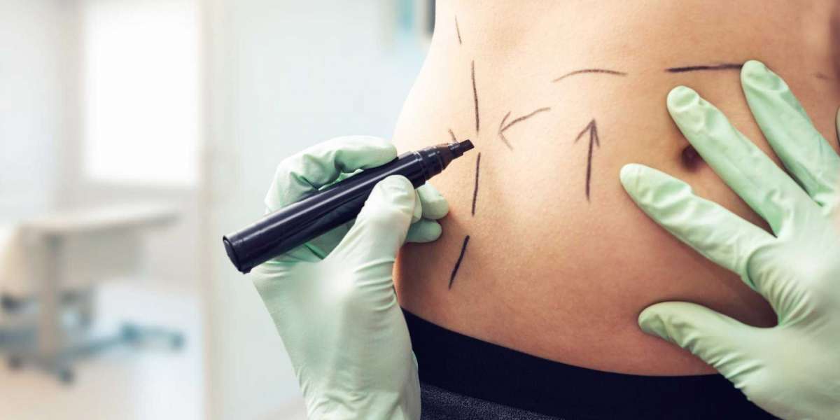 Transform Fat Into Confidence with Laser Liposuction Magic