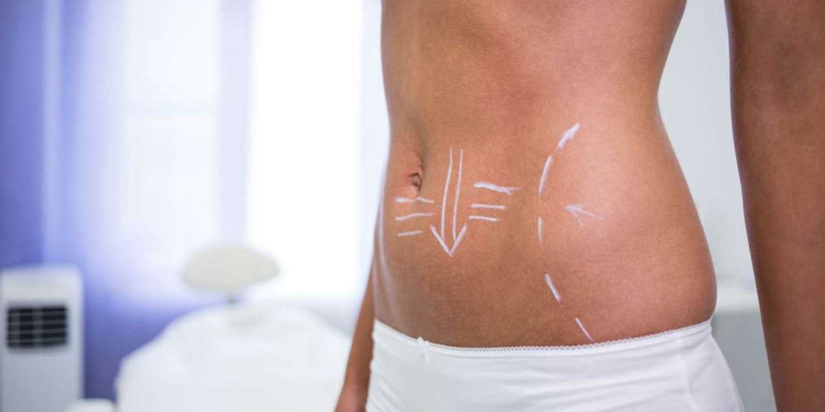 How to Maintain Results After Tummy Tuck Dubai