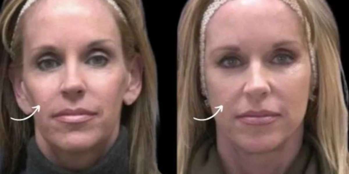 Best Plastic Surgeons in Dubai Reduce Waste During Sculptra Fillers Treatments