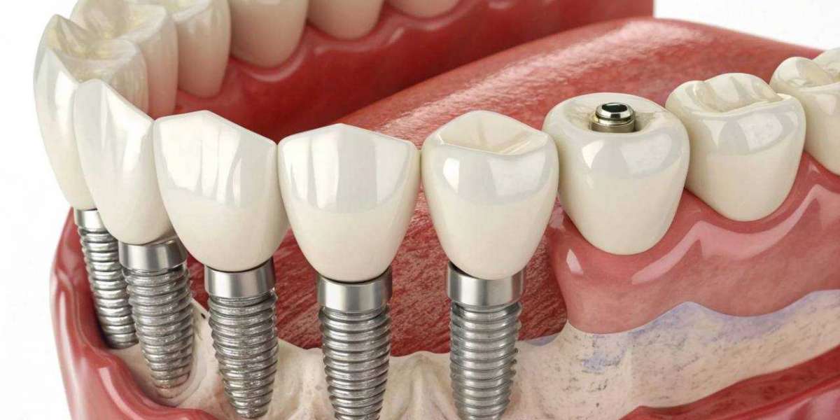 Do Dental Implants in Dubai Reduce Tooth Sensitivity?