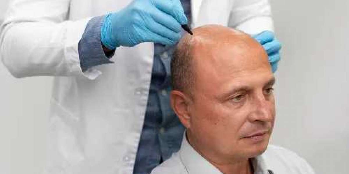 Can Smp Improve Hairline Design and Density?