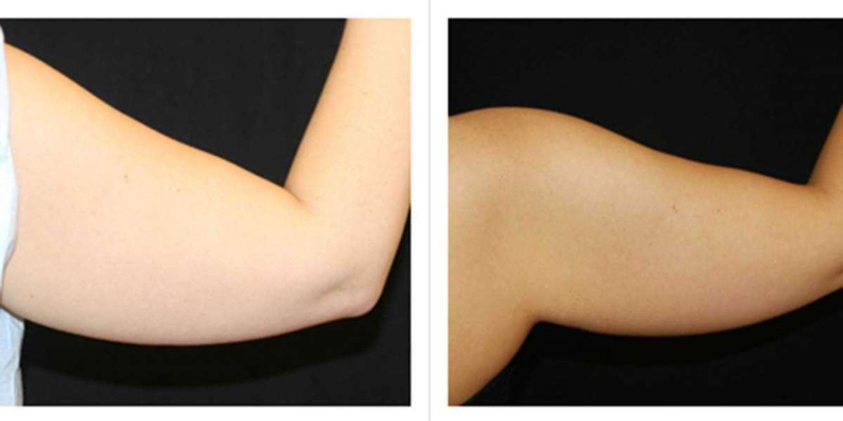Laser Liposuction for Arms: Achieving Toned Upper Arms
