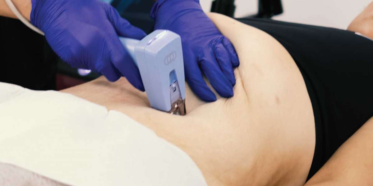 Laser Fat Reduction delivers smooth contour glow for smooth harmony