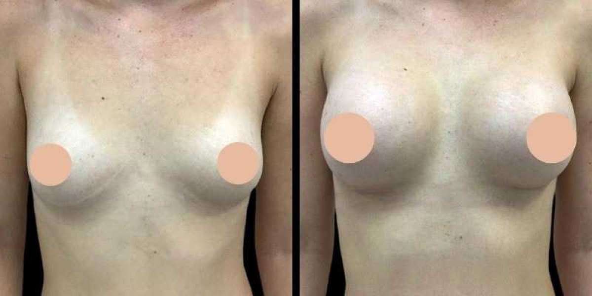 Breast Augmentation in Dubai for Natural-Looking Enhancement