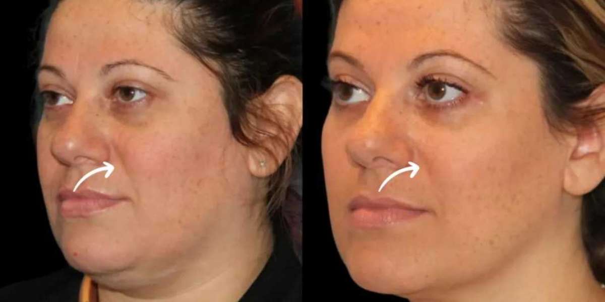Best Plastic Surgeons in Dubai Explore Emotional Goals Behind Sculptra