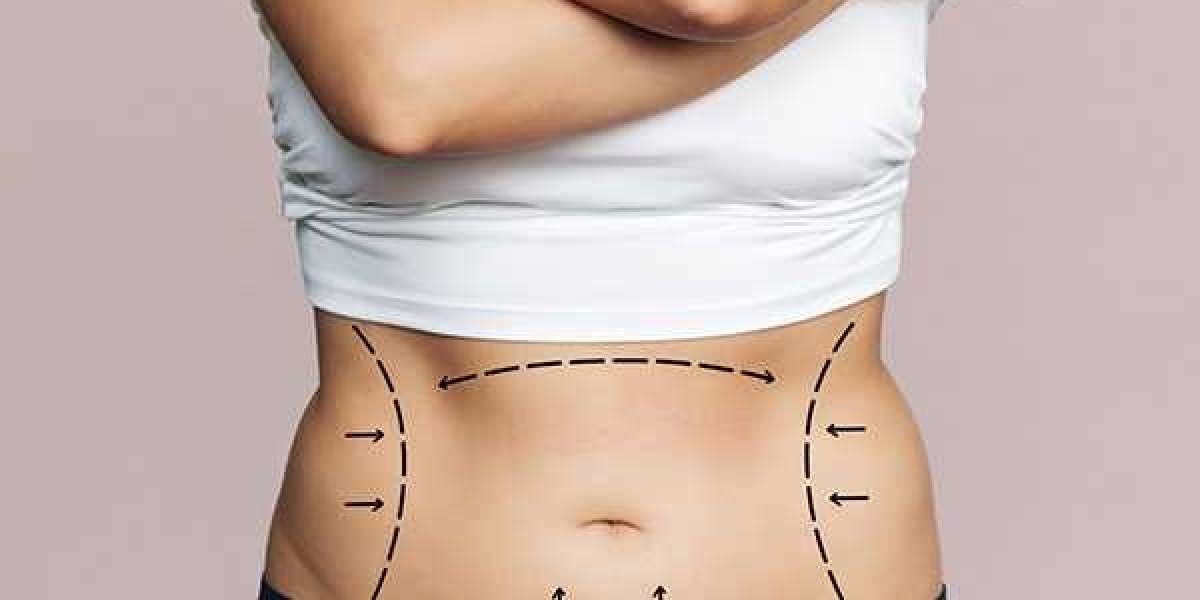Liposuction Dubai: Procedure, Benefits, and Recovery
