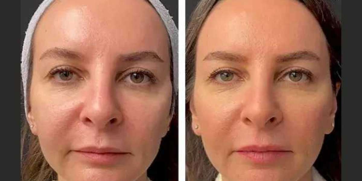 AntiAging Mesotherapy at Best Aesthetic Clinic in Dubai: Benefits & Results