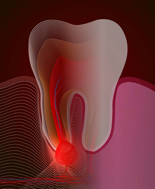 Root Canal Richmond, Hounslow, Palmers Green, Muswell Hill